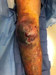 Leg with severe hematoma