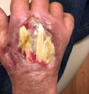 back of a hand with exposed tendons