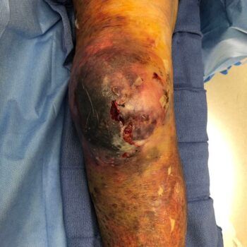 Leg with severe hematoma