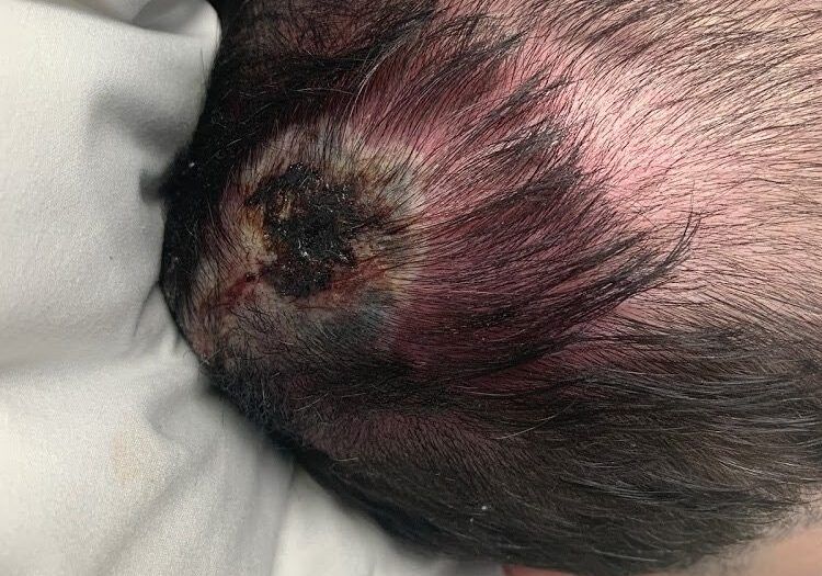 Scalp Abscess