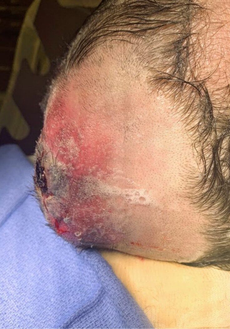 Scalp abscess