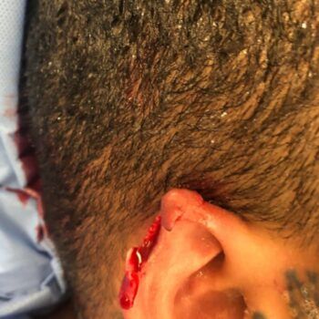 photo of a bleeding ear avulsion