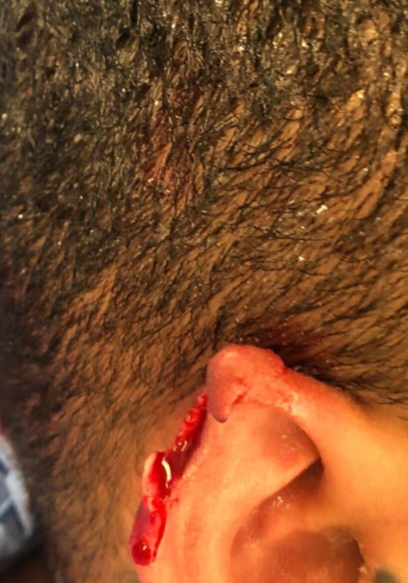 photo of a bleeding ear avulsion