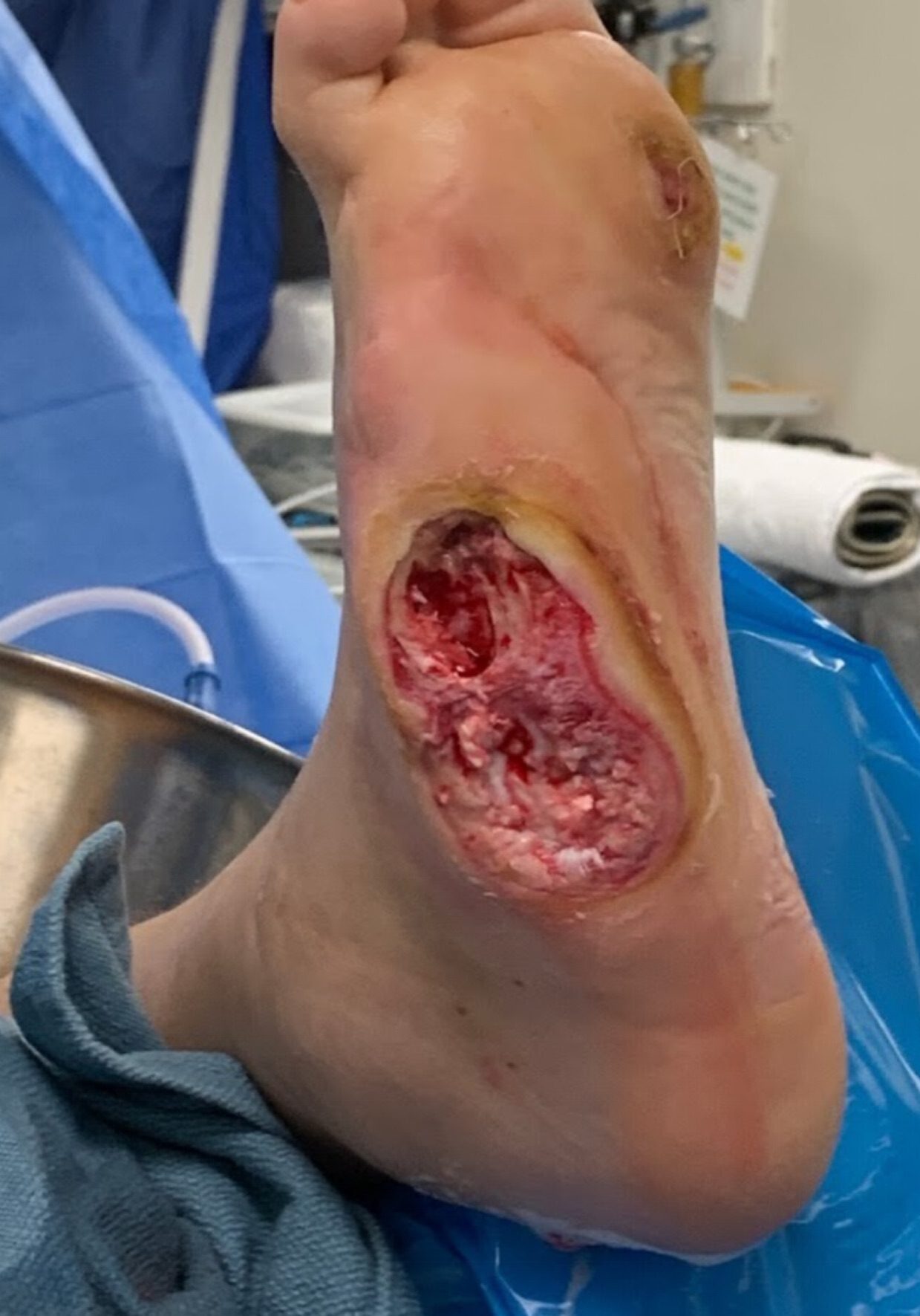 Charcot foot with pressure necrosis
