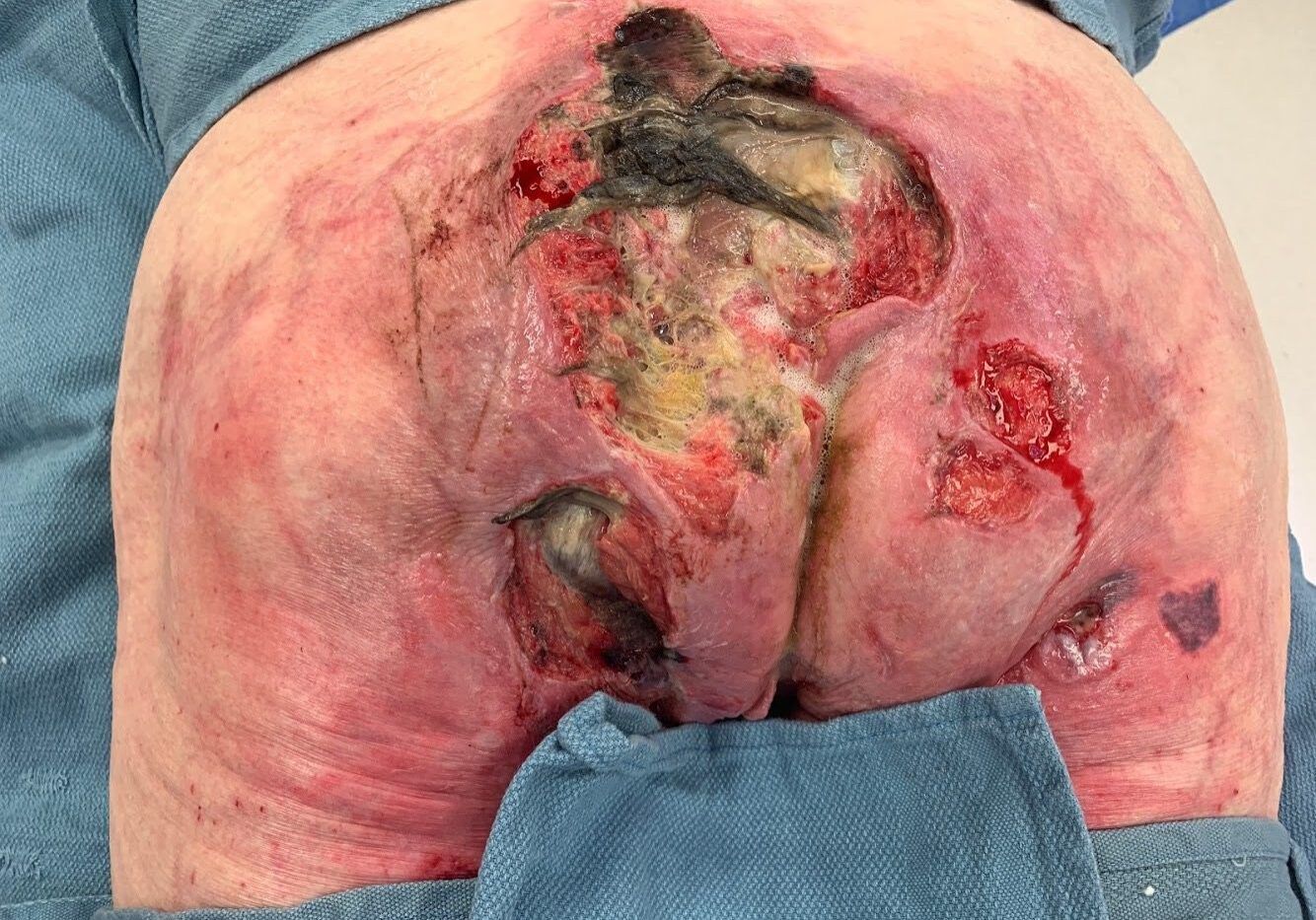 Stage 4 Sacral Ulcer