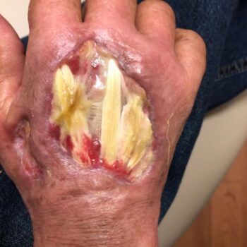 back of a hand with exposed tendons