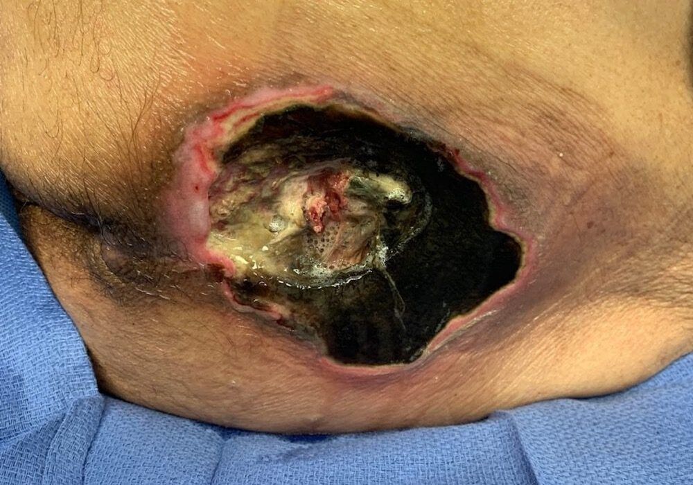 Stage 4 Sacral Ulcer